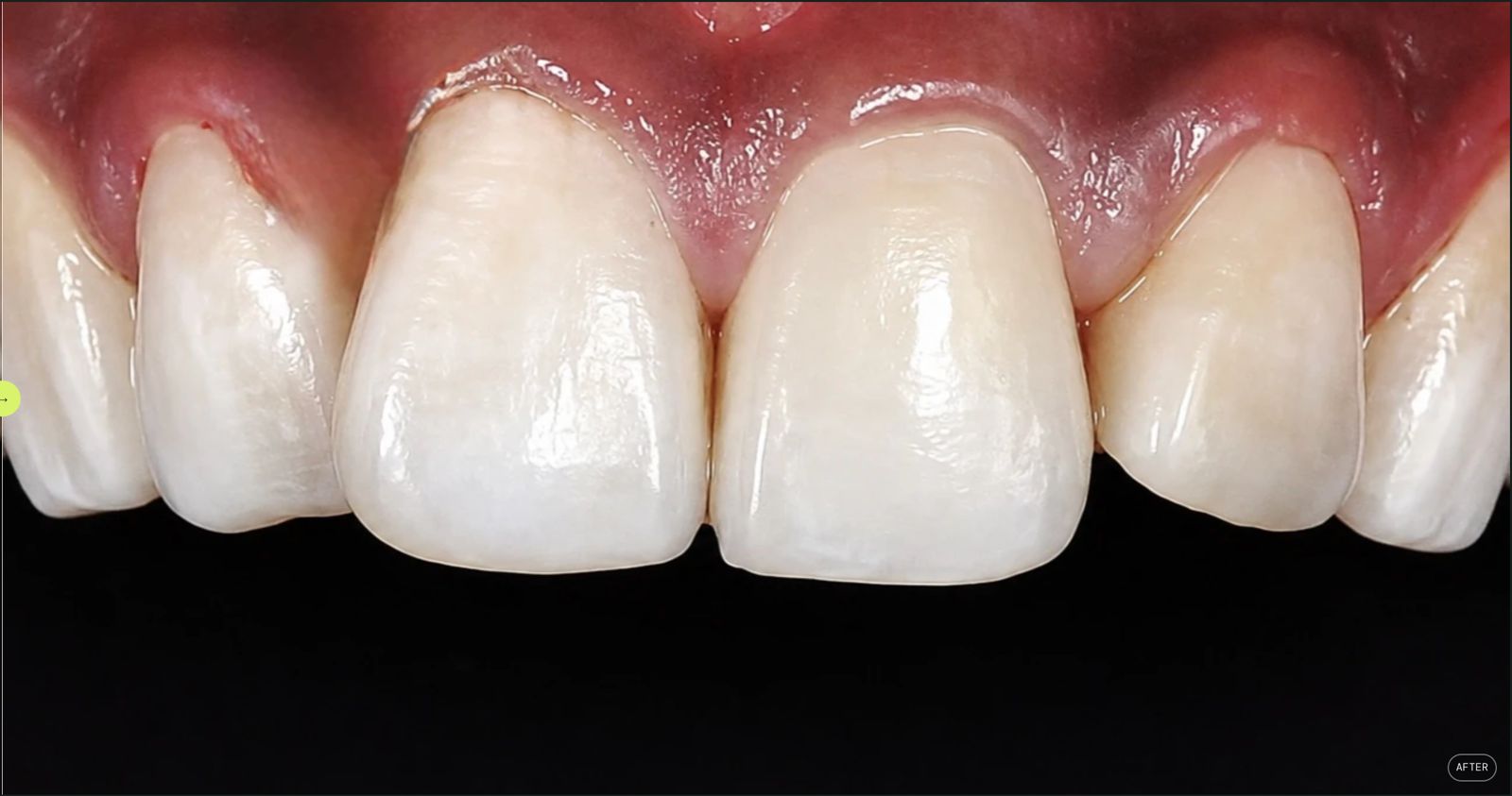 Same patient's front teeth after treatment, staining and discolouration resolved